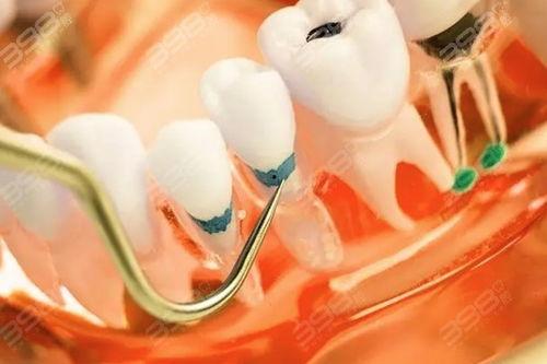 国产牙冠如何辨真伪视频  第2张